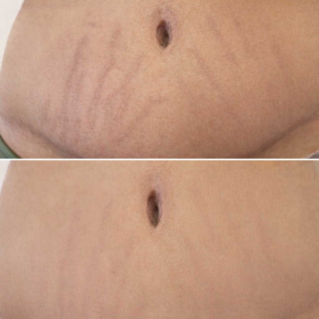 Avant / après résultat client